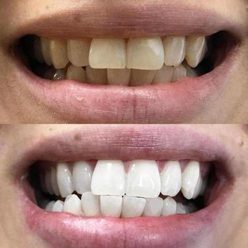 Bleaching Glow Stick - Image 9